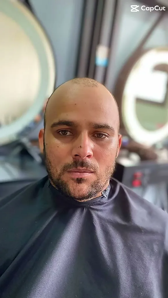 Antes: cliente sem cabelo no topo da cabeça